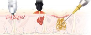 Laserowe usuwanie owłosienia Mediostar, Epilacja , Depilacja laserowa, Powiększanie ust, Botox, Kwas Hialuronowy. Onda. Endermologia LPG Alliance. PODCINANIE BLIZN