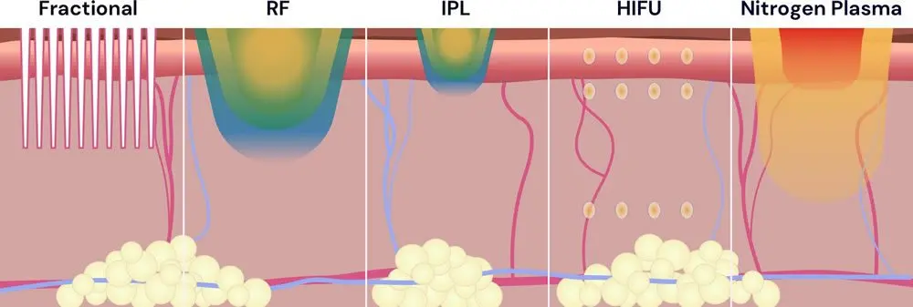 neogen;resurfacing plazmowy; plazma azotowa;